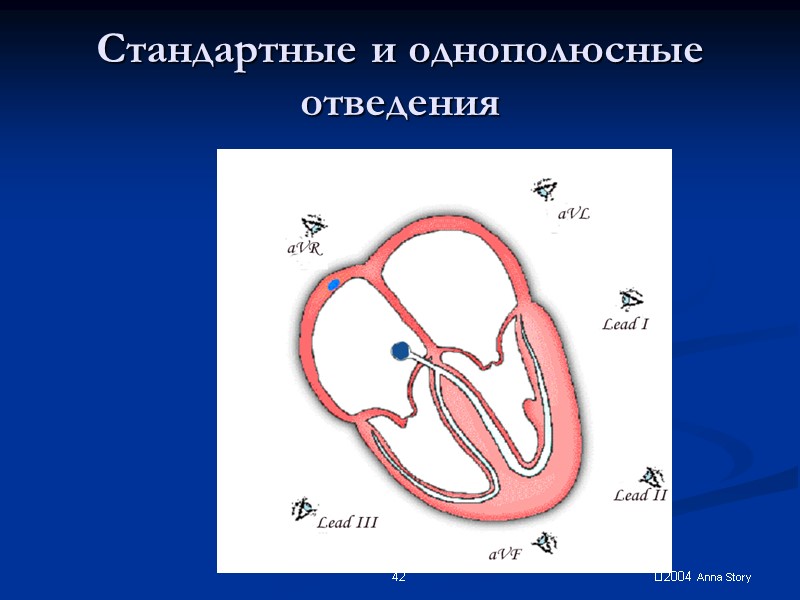 2004 Anna Story 42 Стандартные и однополюсные отведения